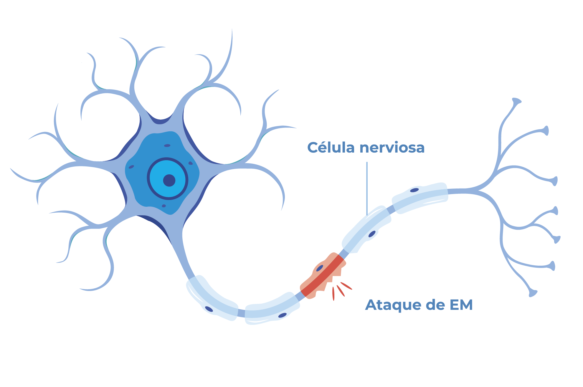 Ilustración de células nerviosas atacantes de MS